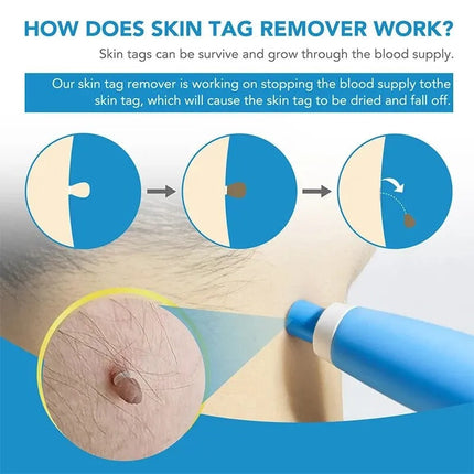 Skin Tag Removal Kit, Skin Tag Removal Tool for Face and Neck – image 7