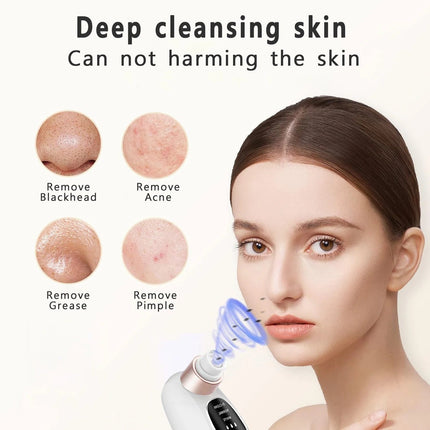 Blackhead Remover Tool Rechargeable 6 Suction Heads, Blackhead Vacuum Pore Cleaner – media 7