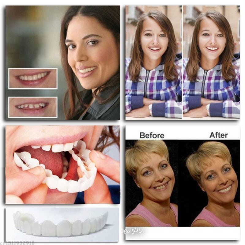 Tuzwa Snap-On Dentures – Natural-Look Temporary Teeth Cover, Adjustable Micro-Thin Reusable Cosmetic Smile Cover