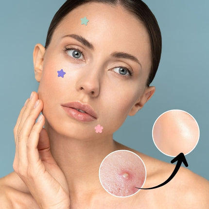 Star Pimple Patches, Hydrocolloid Patch with Salicylic Acid