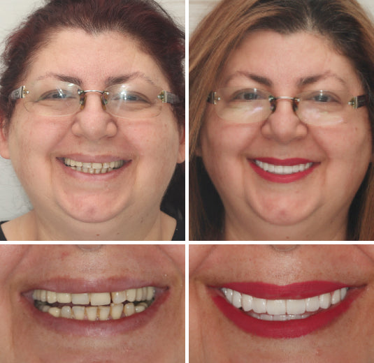 Comfort Dentures | Silicone Complete Set with Tailored Fit | Natural Appearance for Enhanced Confidence 7