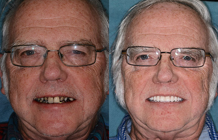 Comfort Dentures | Silicone Complete Set with Tailored Fit | Natural Appearance for Enhanced Confidence 8