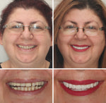Comfort Dentures | Temporary False Teeth Set with Easy Boil-and-Bite Fit | Natural Look for Everyday Confidence 8