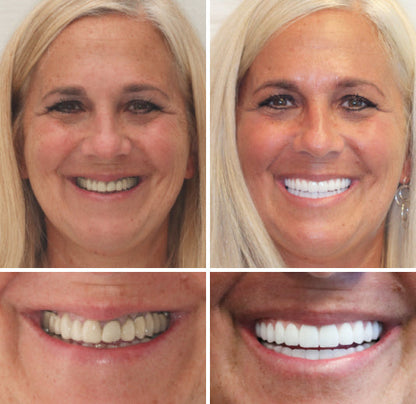 Complete Dentures Set | Custom Fit with Natural Appearance | Comfortable Solution for Enhanced Confidence 4