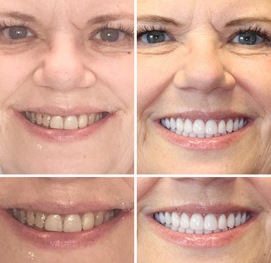 Complete Dentures Set | Natural Appearance with Tailored Fit | Comfortable & Durable for Enhanced Confidence 7