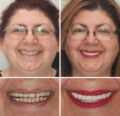 Complete Set of Dentures | Natural-Looking Comfortable False Teeth for Enhanced Confidence 8