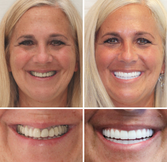 Complete Set of Dentures | Natural-Looking False Teeth with Comfortable Fit | Easy Daily Wear for Confident Smiles 7