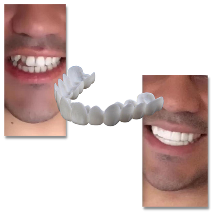 Snap On Veneers, Reusable Teeth Cover