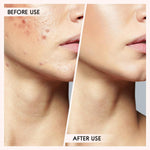 Essential Skin Care | Blackhead & Pimple Extractor Kit with Safe Extraction Tools | Professional Results at Home 7