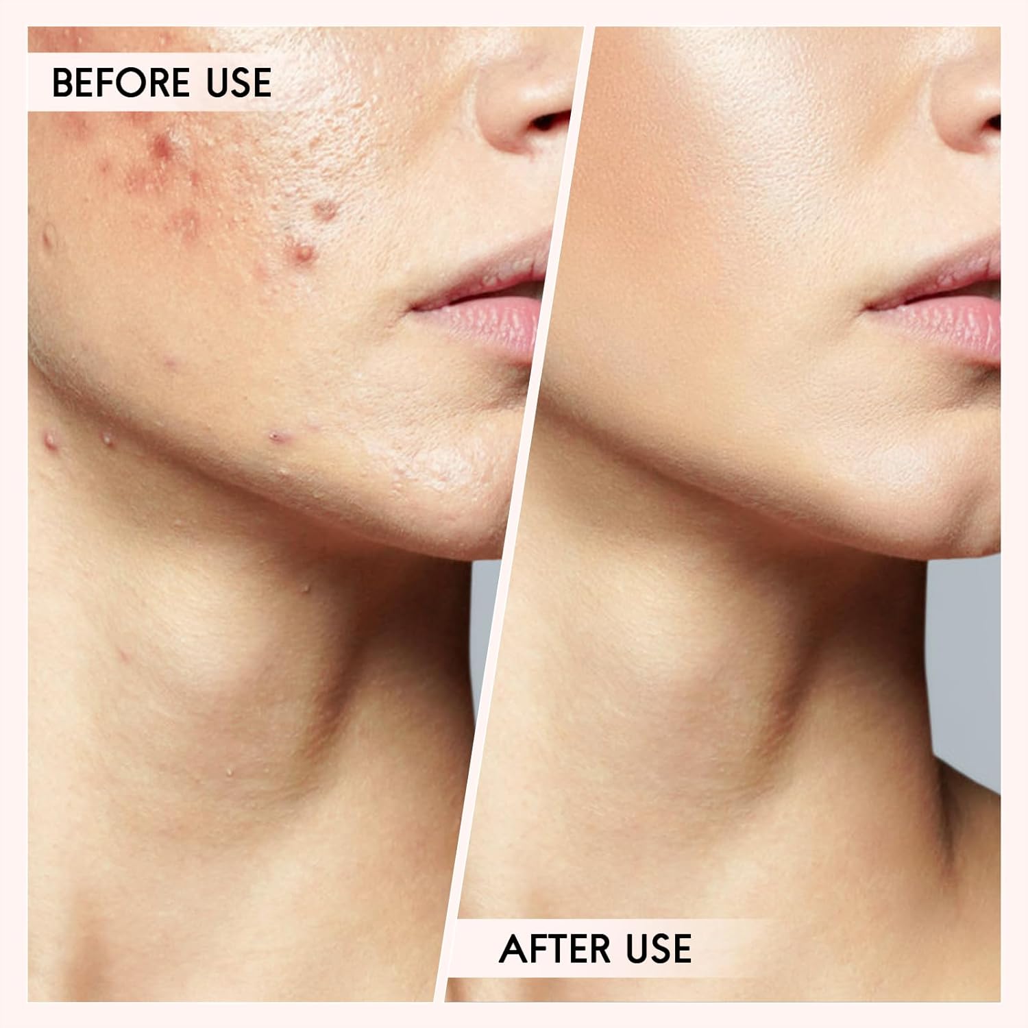 Essential Skin Care | Blackhead & Pimple Extractor Kit with Safe Extraction Tools | Professional Results at Home 7