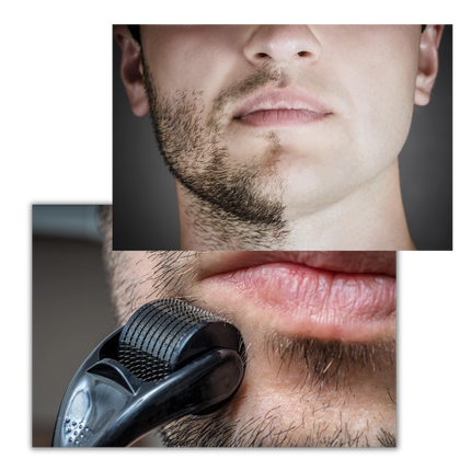 Derma Roller for Hair and Beard Growth, Microneedle Beard Roller for Scalp