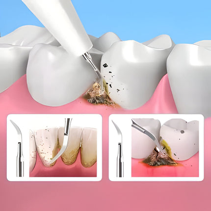 Plaque Remover for Teeth, Ultrasonic Dental Scaler with 3 Modes – image 6