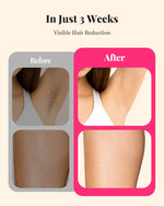 Tuzwa IPL Hair Removal Device with 990,000 Flashes – At-Home Face & Body Hair Remover with Single Lamp Head & Trimmer Attachment