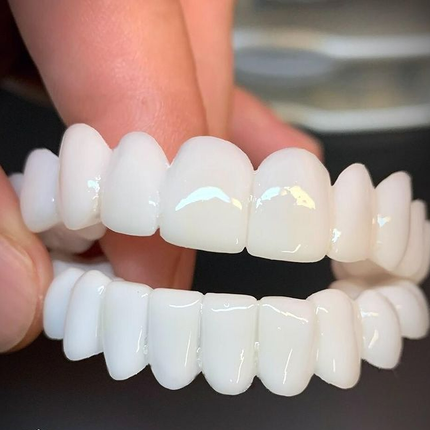 SmileLift | Dental Prosthesis with Customizable Lenses for Natural Appearance | Comfortable Fit for Everyday Confidence 1