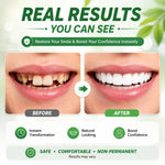 Smile Enhancer | Temporary Teeth Replacement Kit with Custom Fit | Natural-Looking Solution for Missing Teeth 4