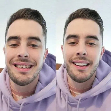 Smile Transformation | Removable Veneers Set with Natural Look | Comfortable Solution for a Perfect Smile 2