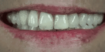 Snap-On Veneers Set for Upper & Lower Teeth with Custom Fit | Removable Solution for a Natural Smile 2