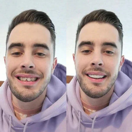 Snap-On Veneers Set for Upper & Lower Teeth with Custom Fit | Removable Solution for a Natural Smile 3