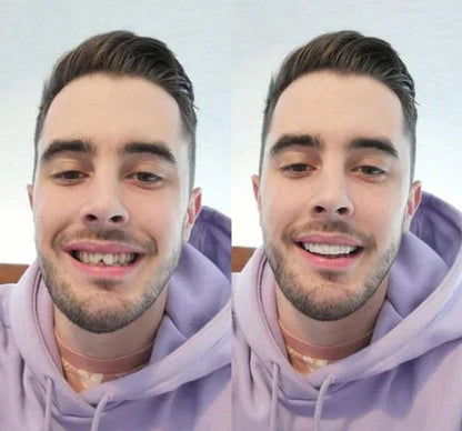 Snap-On Veneers Set for Upper & Lower Teeth with Custom Fit | Removable Solution for a Natural Smile 3