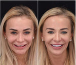 Snap-On Veneers Set for Upper & Lower Teeth with Custom Fit | Removable Solution for a Natural Smile 4