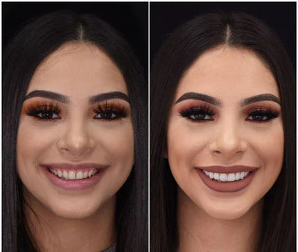 Snap-On Veneers Set for Upper & Lower Teeth with Custom Fit | Removable Solution for a Natural Smile 6
