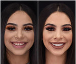Snap-On Veneers Set for Upper & Lower Teeth with Custom Fit | Removable Solution for a Natural Smile 6