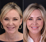 Snap-On Veneers Set for Upper & Lower Teeth with Custom Fit | Removable Solution for a Natural Smile 7