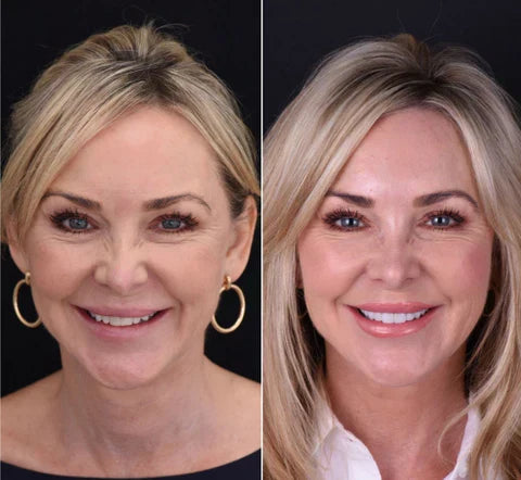 Snap-On Veneers Set for Upper & Lower Teeth with Custom Fit | Removable Solution for a Natural Smile 7