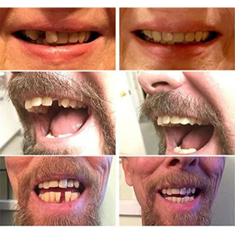 Wearclo | High-Quality False Teeth with Natural Appearance | Comfortable Temporary Dentures for Instant Confidence 2