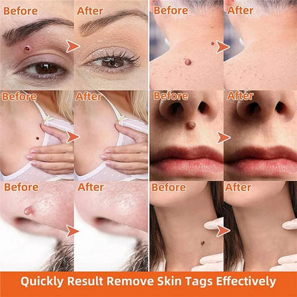 Skin Tag Remover Painless Auto Spring Kit