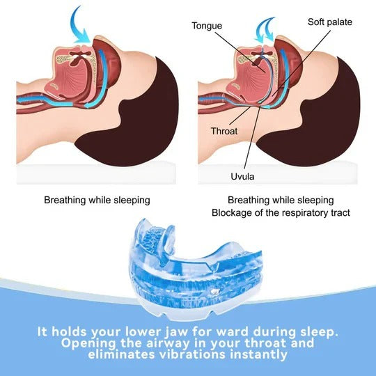 Tuzwa Adjustable Anti-Snore Mouthpiece – Custom Moldable Snoring Mouthpiece with Screw-Based Fit Control, Washable & Reusable Design