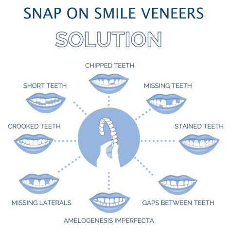 Tuzwa Clip-On Veneers – Natural-Looking Removable Cosmetic Teeth Cover for Temporary Smile Enhancement
