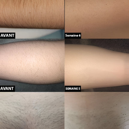 Laser Hair Removal Device for Body, At Home Laser Hair Removal – image 8